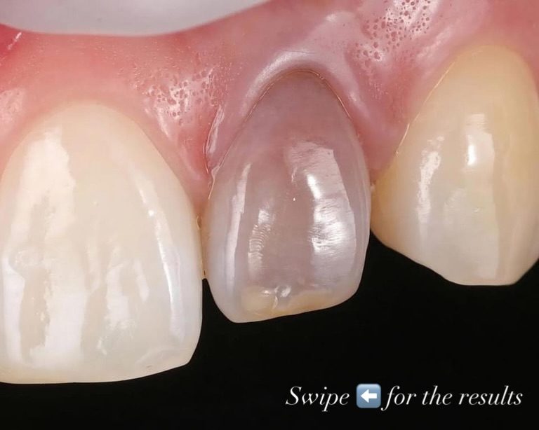 Smile Makeover — before