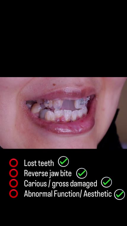 Full-Mouth Rehabilitation