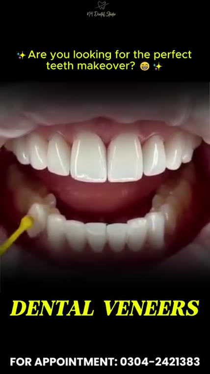 The Magic of Veneers