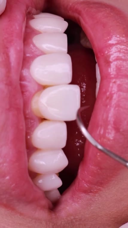 Ultra-Thin Veneers