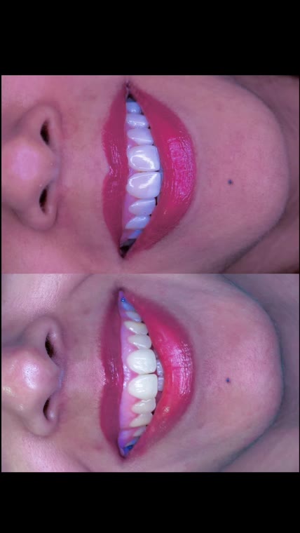 Veneer Perfection
