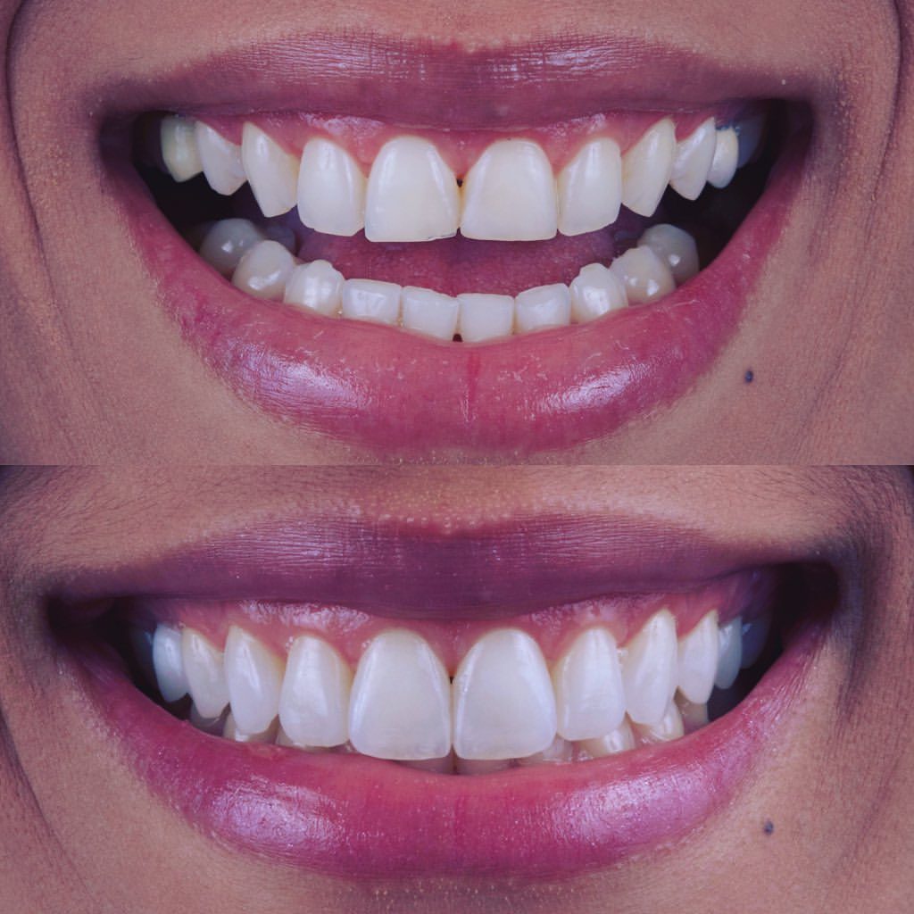 Aesthetic Veneers